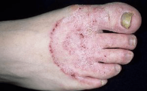 Grybelio atsiradimo ant kojų priežastys