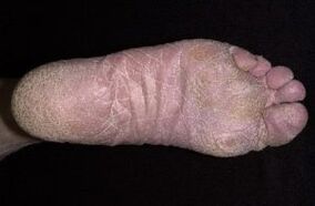 Grybelio požymiai ir simptomai ant kojų