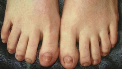 Nagų grybelio kūrimo etapai