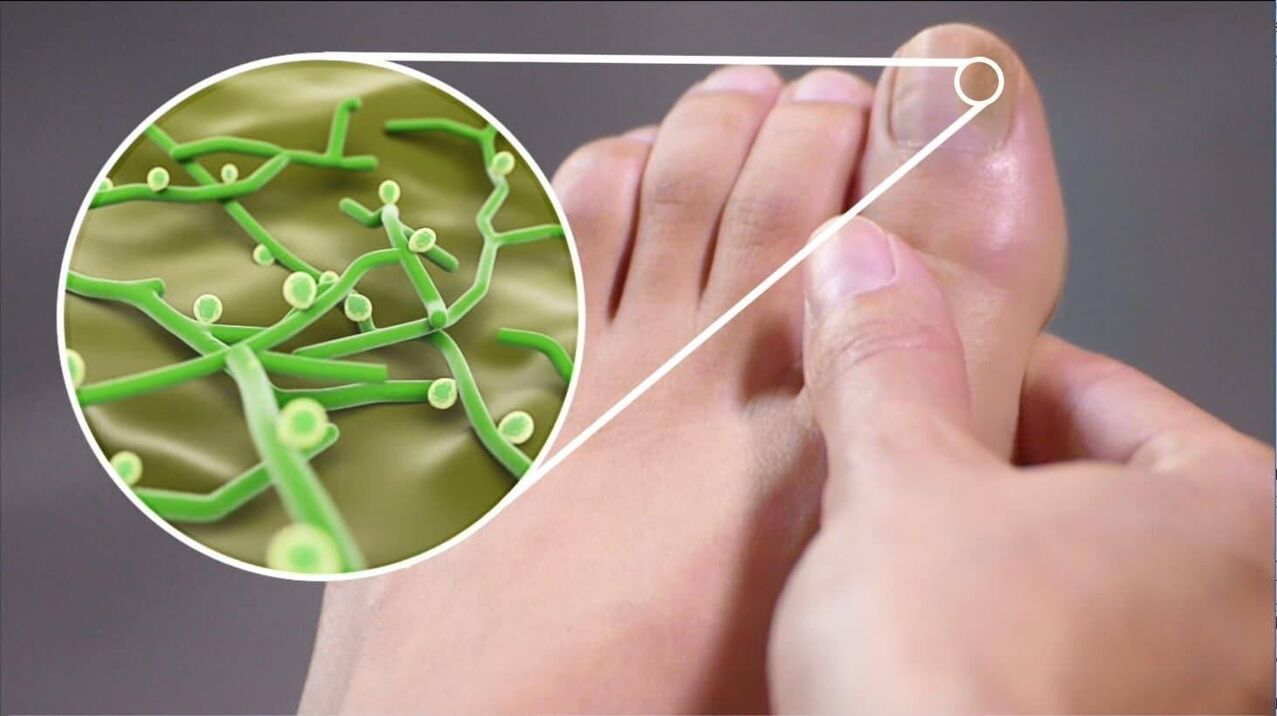 kojų nagų grybelio sukėlėjai