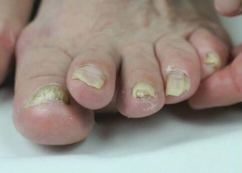 nagų grybelio gydymas vaistais