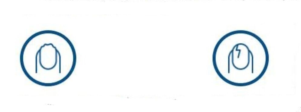 nagų deformacija dėl grybelinės infekcijos