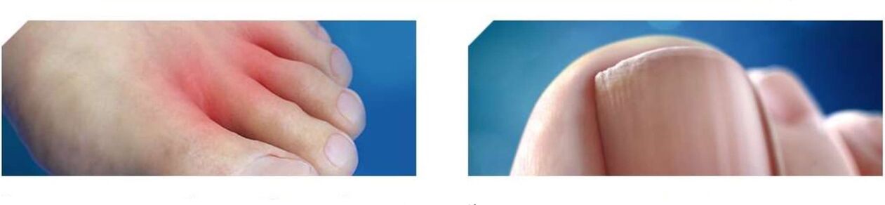 pradinė pėdų grybelio stadija